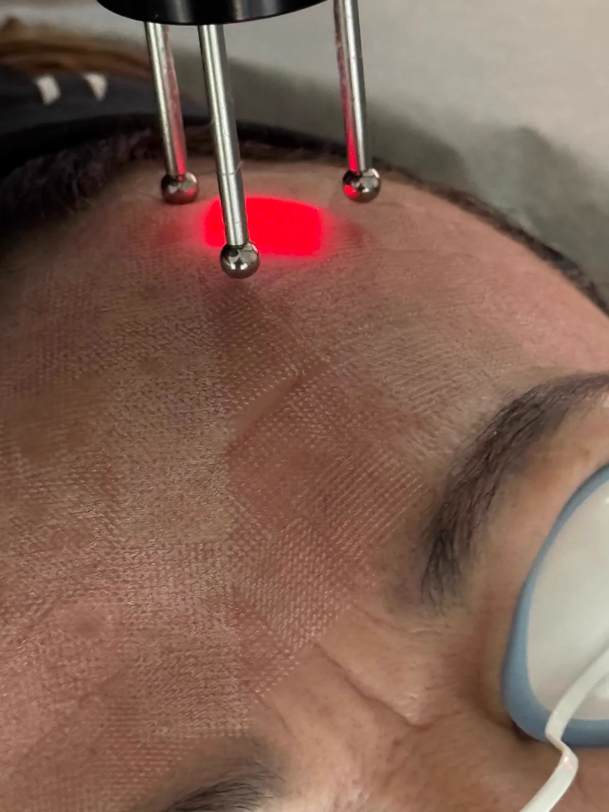 Close view of the laser handpiece at the forehead during treatment