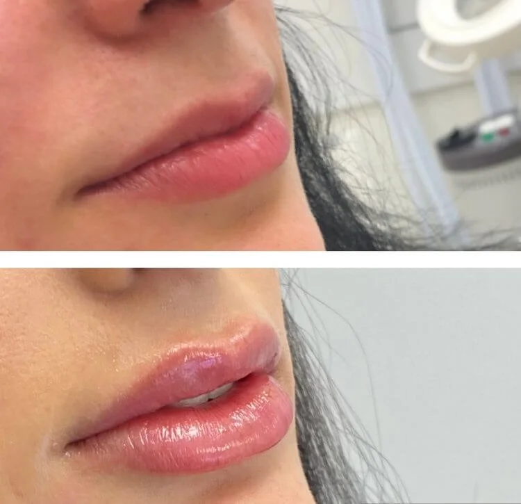 Lip filler before and after side profile