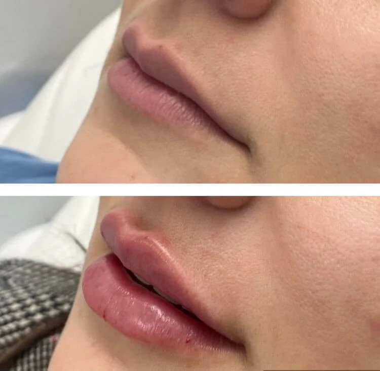 Lip filler before and after angled profile