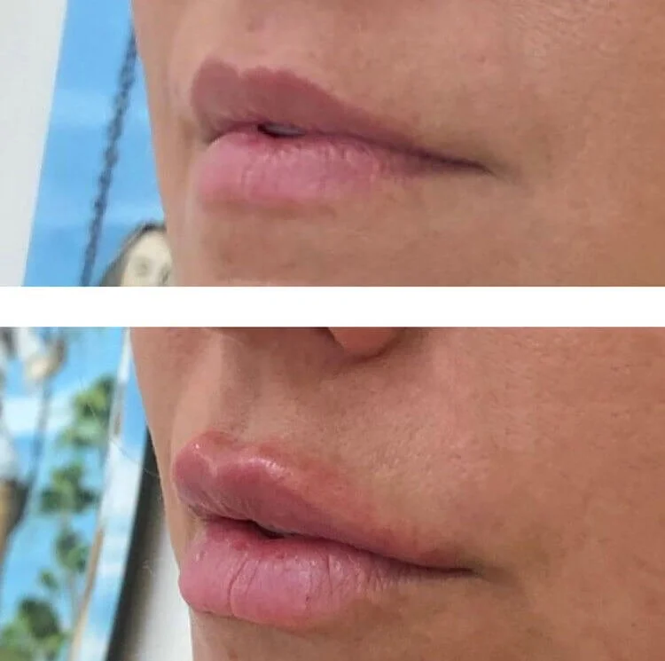 Lip filler before and after close-up