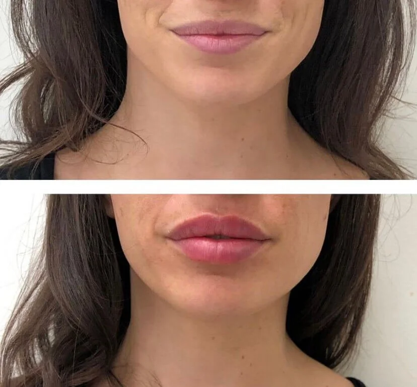 Lip filler before and after lower-face view