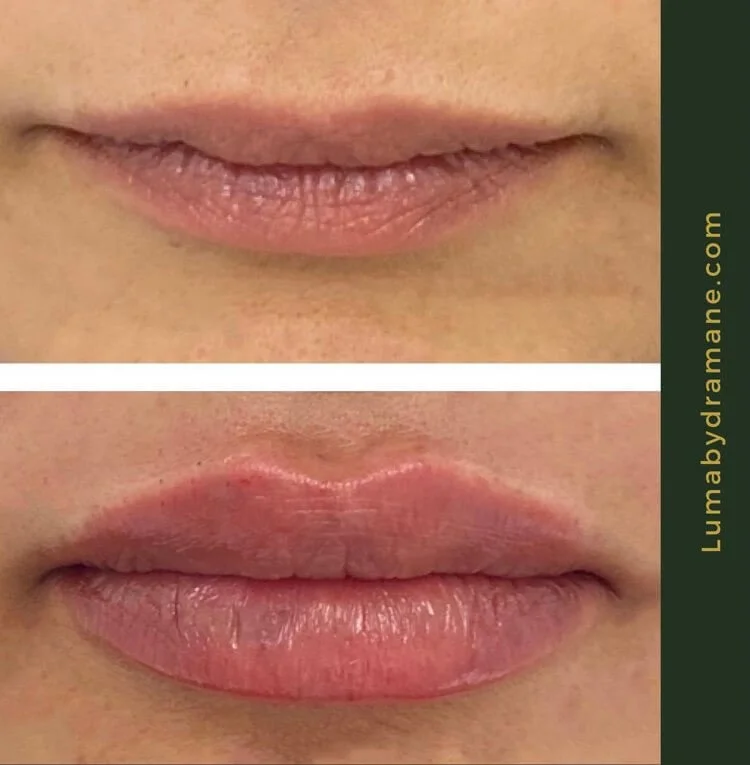 Lip filler before and after frontal close-up