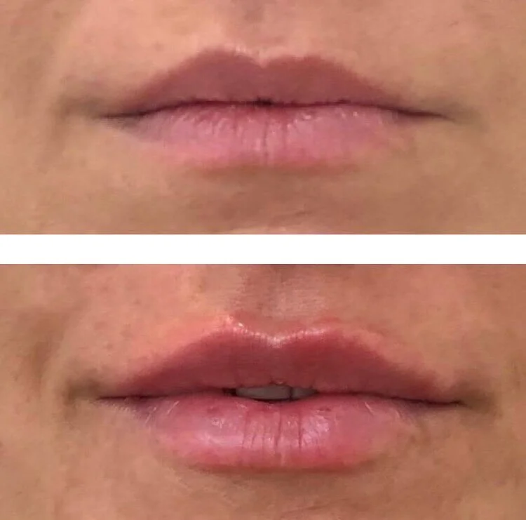 Lip filler before and after frontal comparison