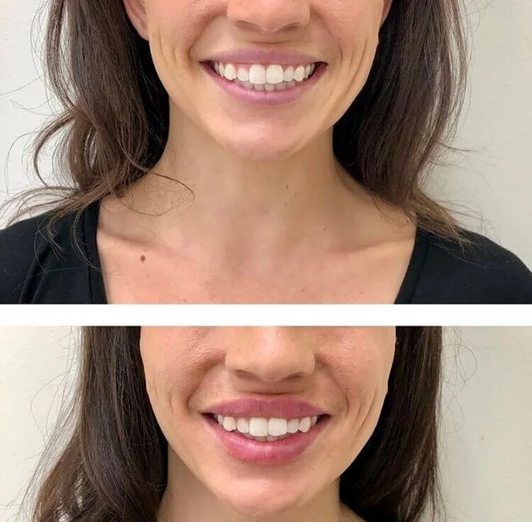 Lip filler before and after smile comparison