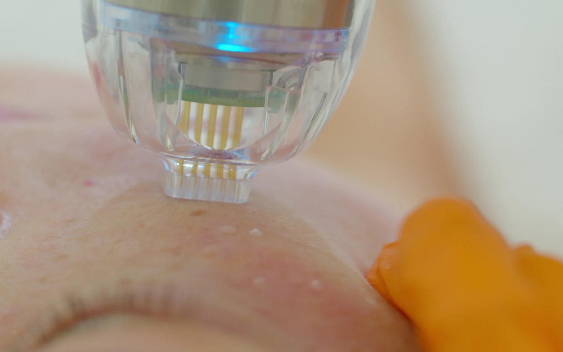 Microneedling treatment details at luma