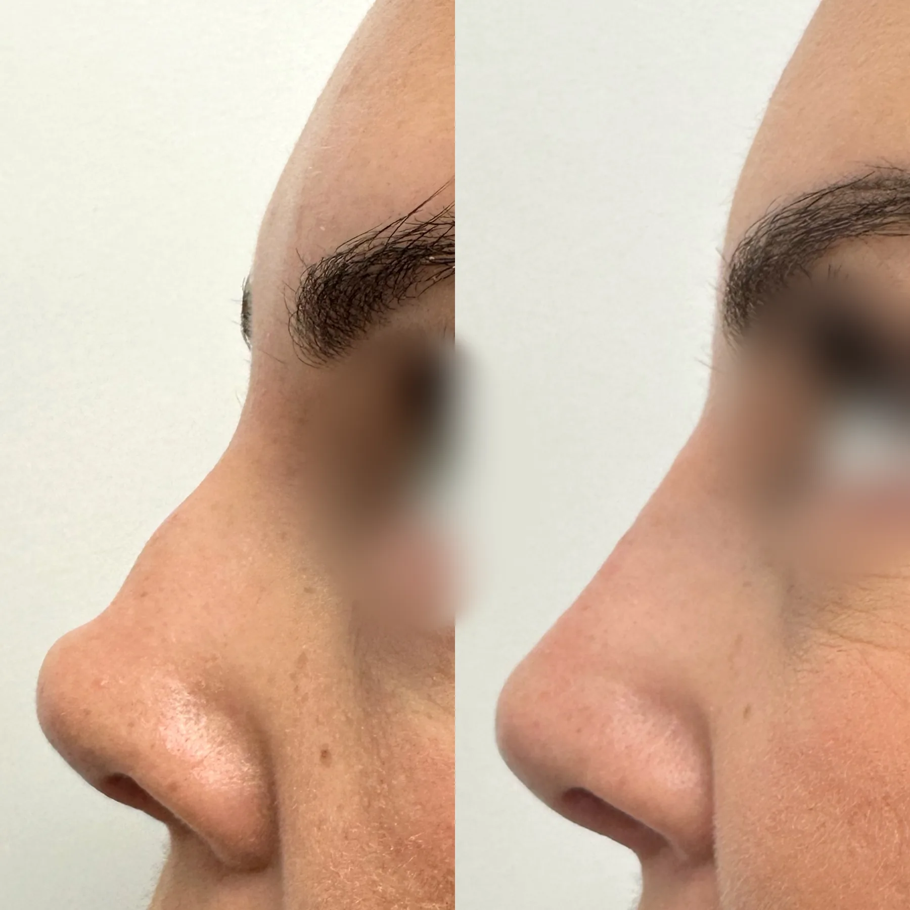 Non-surgical rhinoplasty, side profile, before and immediately after