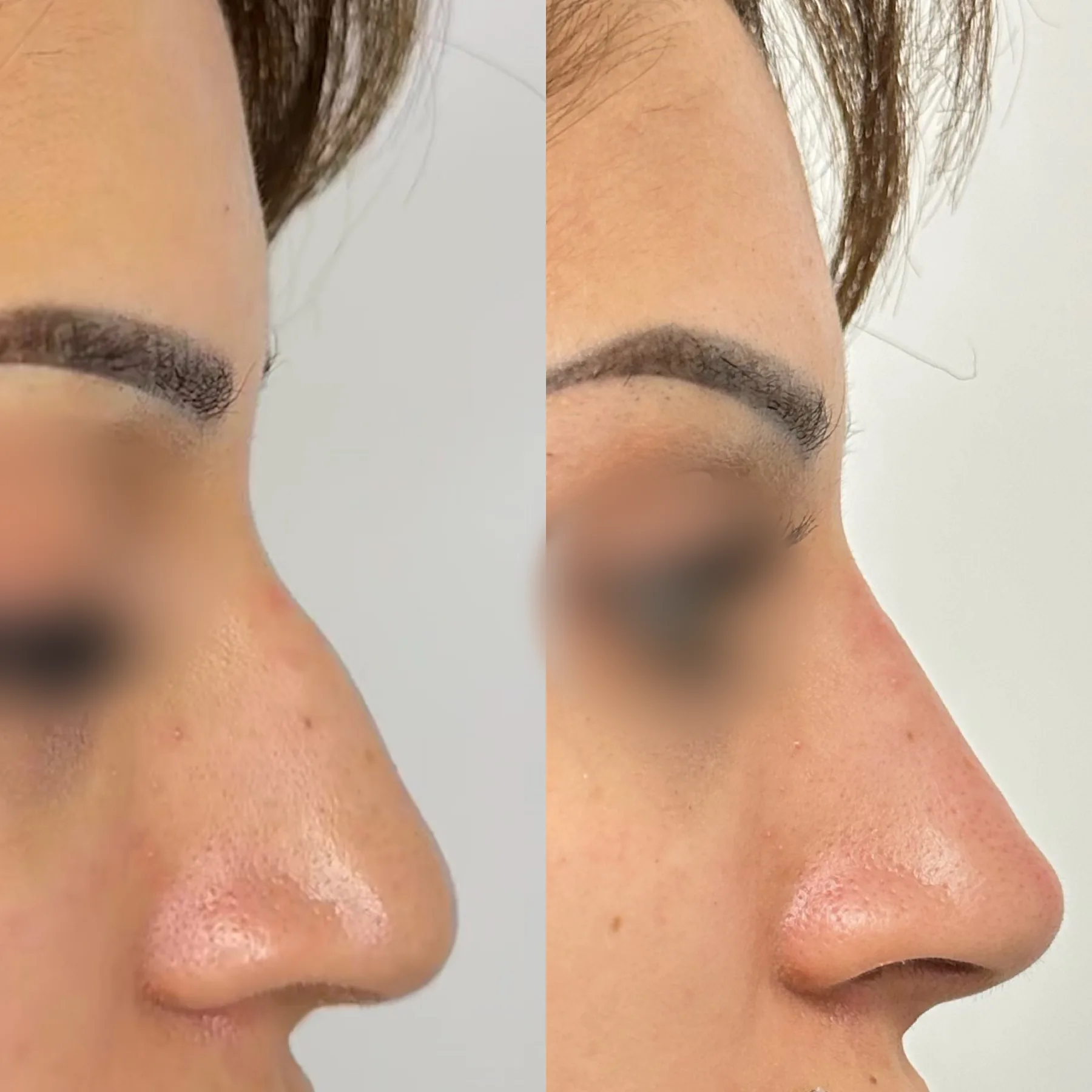 Non-surgical rhinoplasty, three-quarter view, before and immediately after