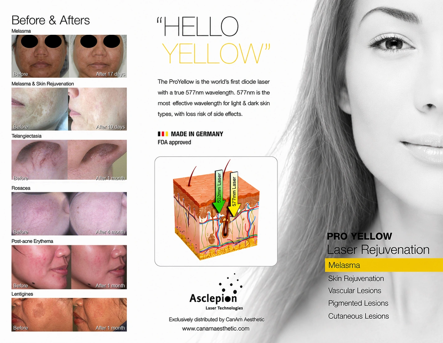 ProYellow laser treatment detail at luma