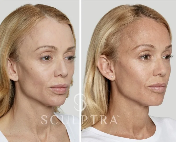 Sculptra before and after treatment planning at luma